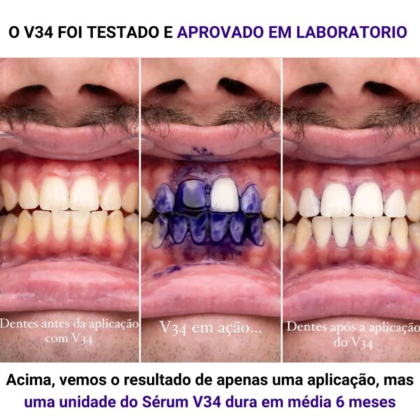 V34 Purple: Hismile V34 clareador dental