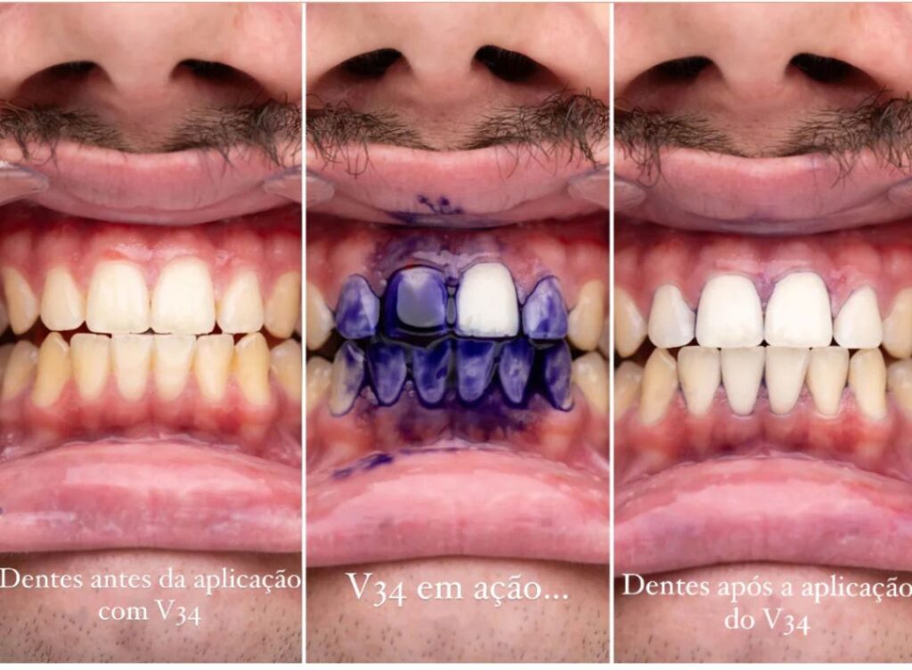 What Is the V34 Purple Toothpaste For?