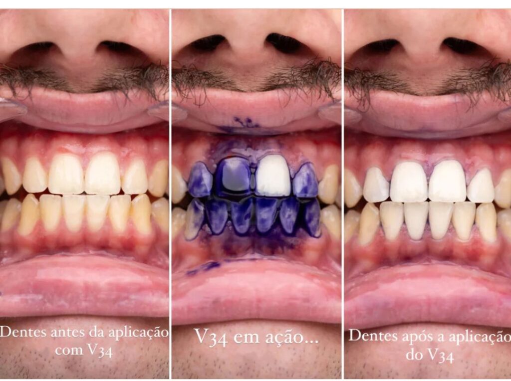 V34 Teeth Whitening Serum: Learn More