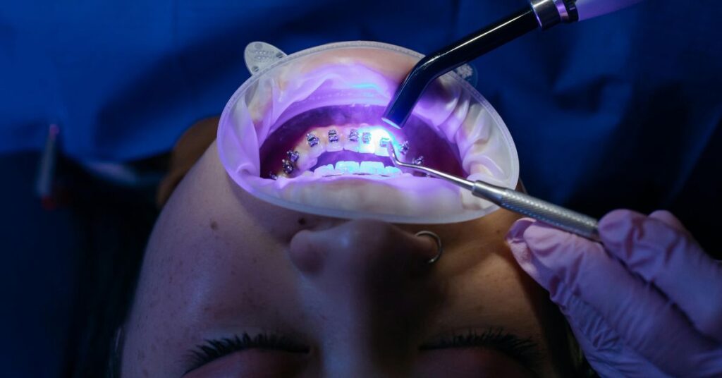 Fita roxa clareadora dental Funciona? Será que vale apena