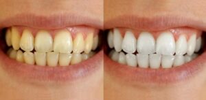 Fita clareadora dental roxa: 14 Unidades