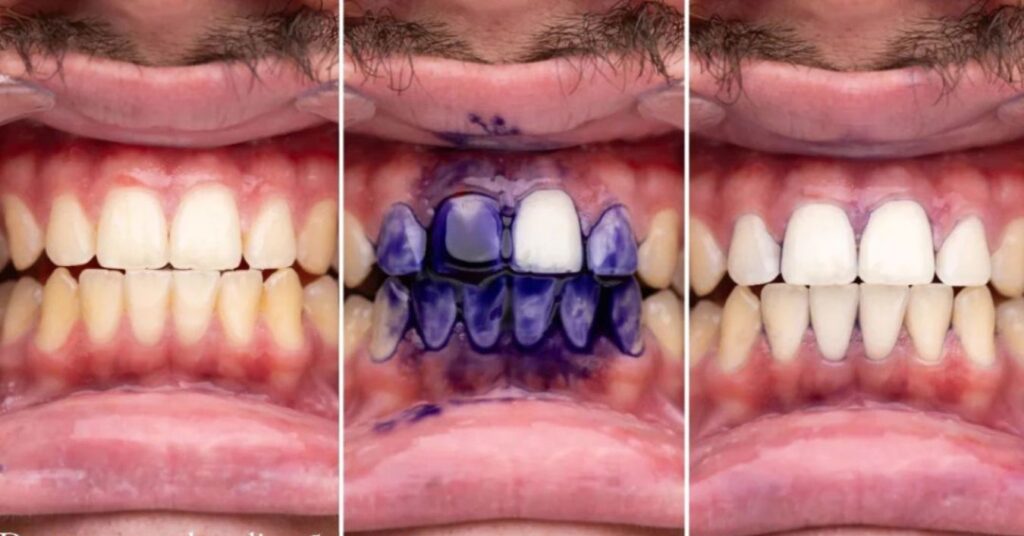 Fita clareadora dental roxa funciona mesmo