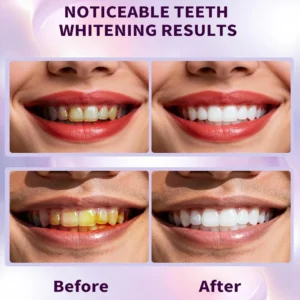 Tiras Clareadoras Dental Roxas - Sem Sensibilidade