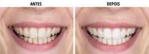 Tiras de clareamento de dentes roxo Oralhoe: Strips v34 Oralhoe