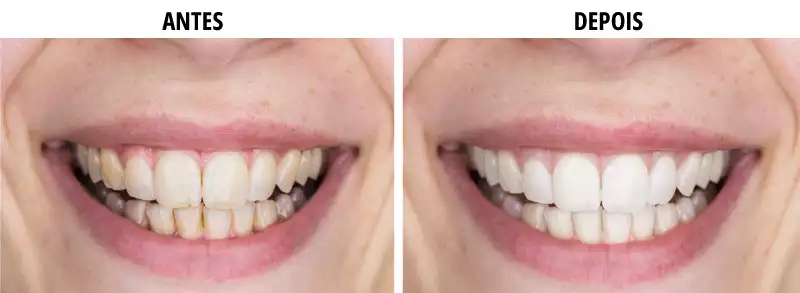 Tiras clareadora dental onde comprar em portugal online